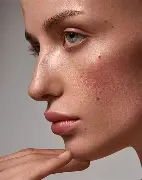 quitar las manchas en la cara - ipl4 rosacea 1