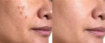 quitar las manchas en la cara - ipl6 manchas 1